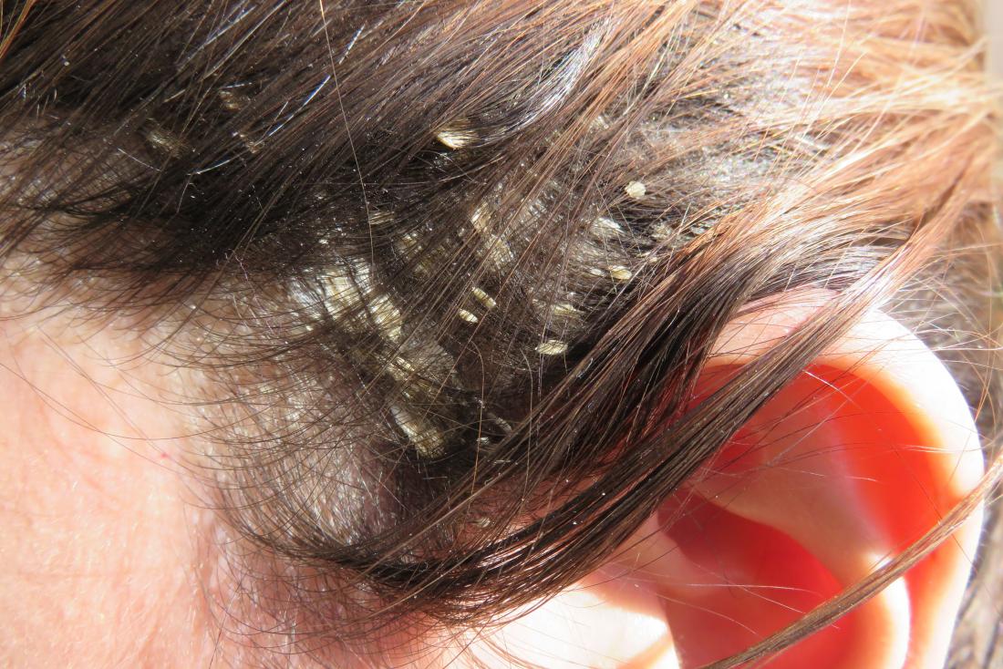 ¿Caspa o irritación del cuero cabelludo?