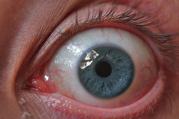 El síndrome del ojo seco. Todo lo que debes saber
