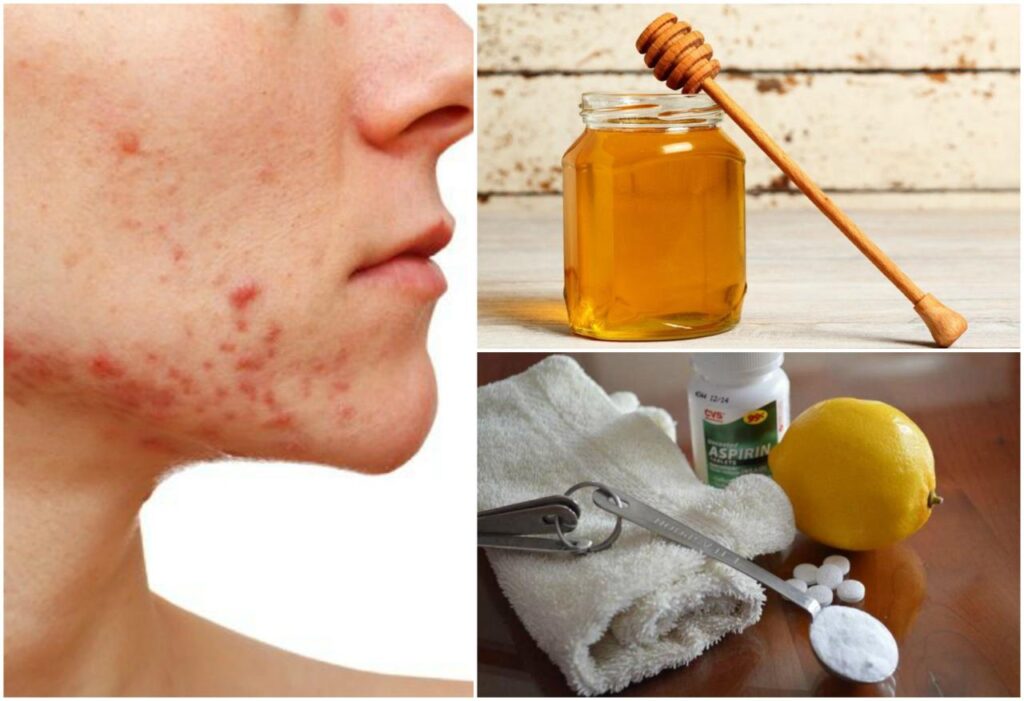 Los seis remedios caseros para combatir el acné