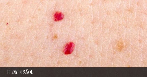 Los puntos rojos en la piel ¿son peligrosos?